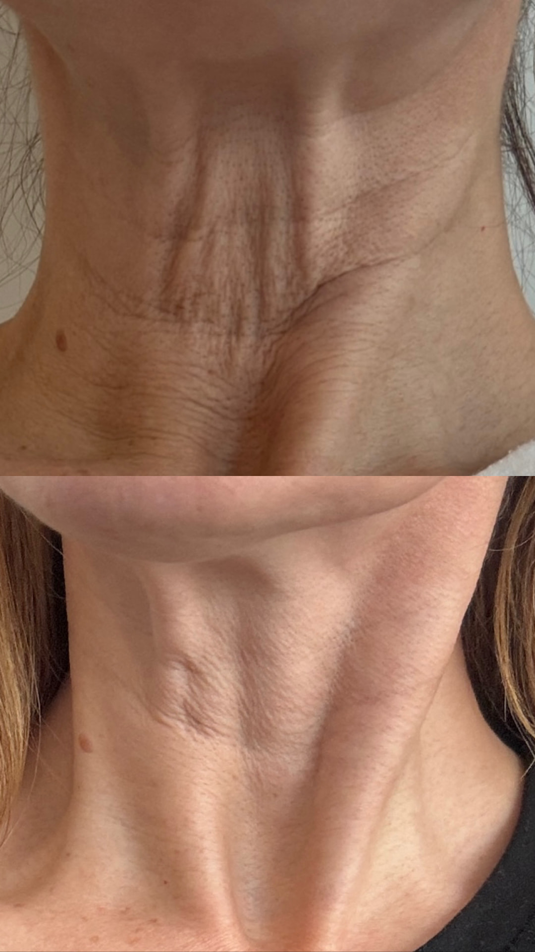 Two supplied photographs showing a neck before treatment above and after treatment below