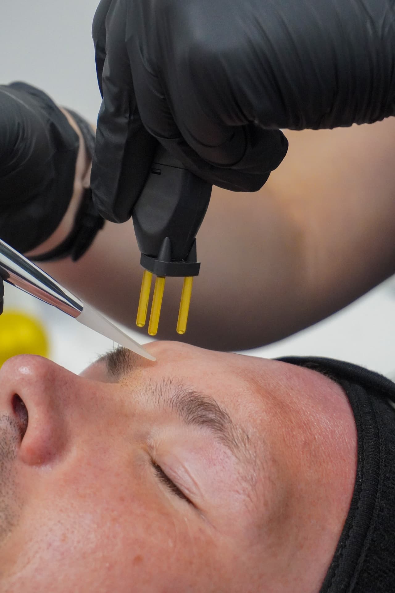 NeoGen handpiece positioned above a man's forehead during treatment
